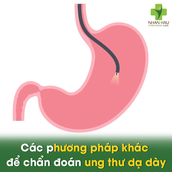 Siêu Âm Có Phát Hiện Được Ung Thư Dạ Dày Không? Sự Thật Ít Ai Biết! 4 Các phương pháp khác để chẩn đoán ung thư dạ dày