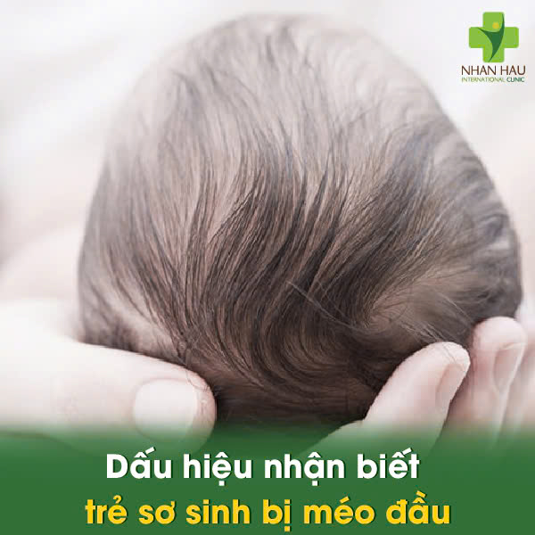 Vật lý trị liệu méo đầu cho trẻ sơ sinh: Giải pháp cải thiện cho con trẻ 2 Dấu hiệu nhận biết trẻ sơ sinh bị méo đầu