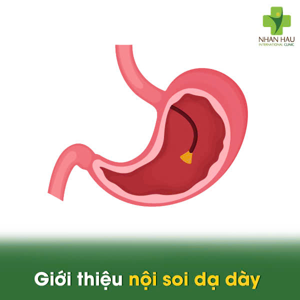 Nội Soi Dạ Dày Có Phát Hiện Ung Thư Dạ Dày Không? Giải Đáp Thắc Mắc 1 Giới thiệu nội soi dạ dày