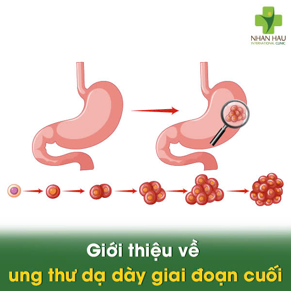 Ung Thư Dạ Dày Giai Đoạn Cuối: Cùng Tìm Hiểu Cách Điều Trị và Chăm Sóc 1 Giới thiệu về ung thư dạ dày giai đoạn cuối