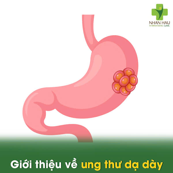 Ung Thư Dạ Dày Có Chữa Khỏi Được Không Và Tỷ Lệ Là Bao Nhiêu 1 Giới thiệu về ung thư dạ dày