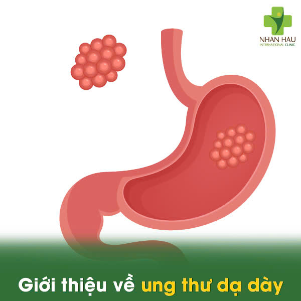 Tổng Quan Về Chi Phí Điều Trị Ung Thư Dạ Dày: Những yếu tố ảnh hưởng đến chi phí 1 Giới thiệu về ung thư dạ dày