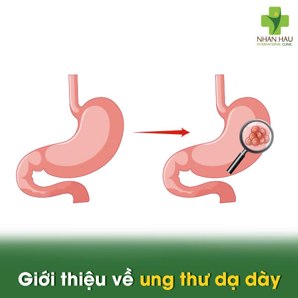 Những Dấu Hiệu Cảnh Báo Ung Thư Dạ Dày Bạn Không Nên Bỏ Qua 1 Giới thiệu về ung thư dạ dày