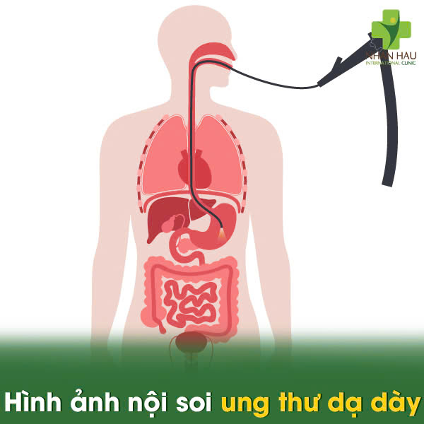 Nội Soi Dạ Dày Có Phát Hiện Ung Thư Dạ Dày Không? Giải Đáp Thắc Mắc 3 Hình ảnh nội soi ung thư dạ dày