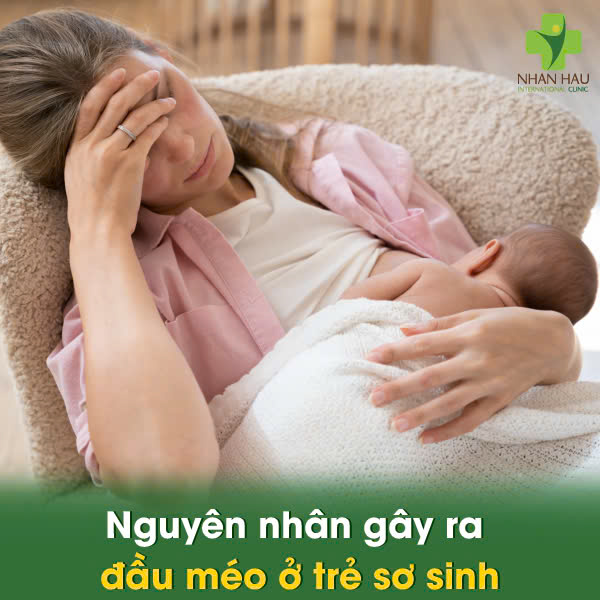 Vật lý trị liệu méo đầu cho trẻ sơ sinh: Giải pháp cải thiện cho con trẻ 3 Nguyên nhân gây ra đầu méo ở trẻ sơ sinh