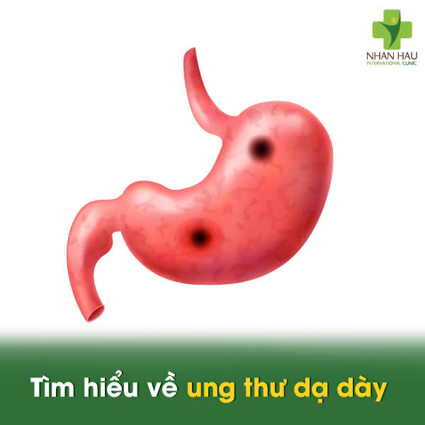 Ung thư dạ dày sống được bao lâu? Yếu tố ảnh hưởng đến tỷ lệ sống 1 Tìm hiểu về ung thư dạ dày
