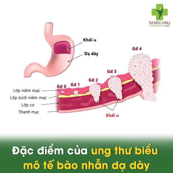 Ung Thư Biểu Mô Tế Bào Nhẫn Dạ Dày: Hiếm gặp nhưng cần cảnh giác! 2 Đặc điểm của ung thư biểu mô tế bào nhẫn dạ dày