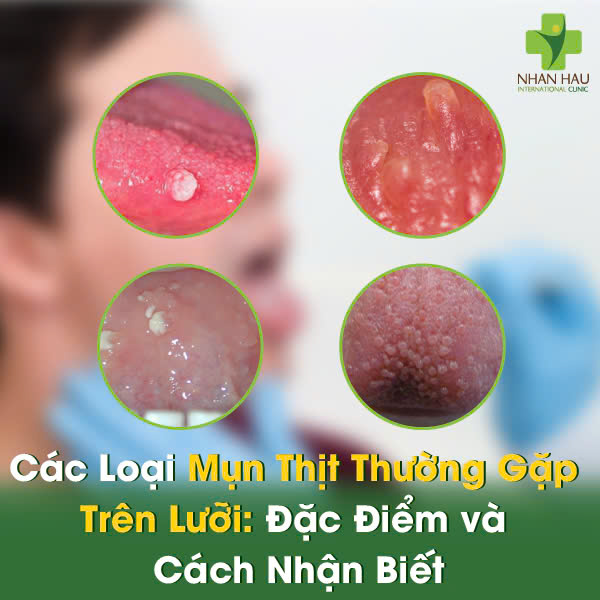 Lưỡi Nổi Mụn Thịt: Phân Biệt Loại Mụn, Nguyên Nhân và Cách Điều Trị Hiệu Quả 3 Các Loại Mụn Thịt Thường Gặp Trên Lưỡi: Đặc Điểm và Cách Nhận Biết