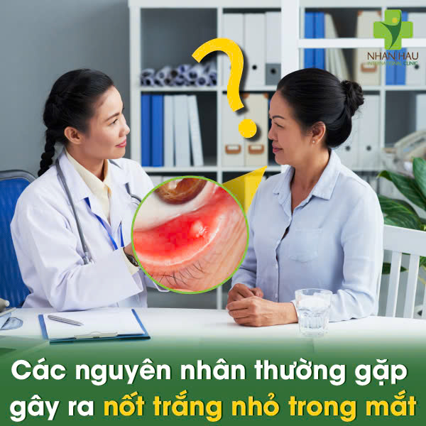 Phát Hiện Nốt Trắng Nhỏ Trong Mắt? Giữ Bình Tĩnh và Tìm Hiểu Nguyên Nhân! 2 Các nguyên nhân thường gặp gây ra nốt trắng nhỏ trong mắt