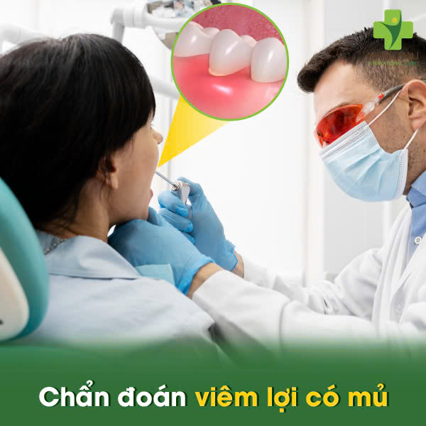 Viêm Lợi Có Mủ: Nguyên Nhân và Cách Điều Trị An Toàn 4 Chẩn đoán viêm lợi có mủ