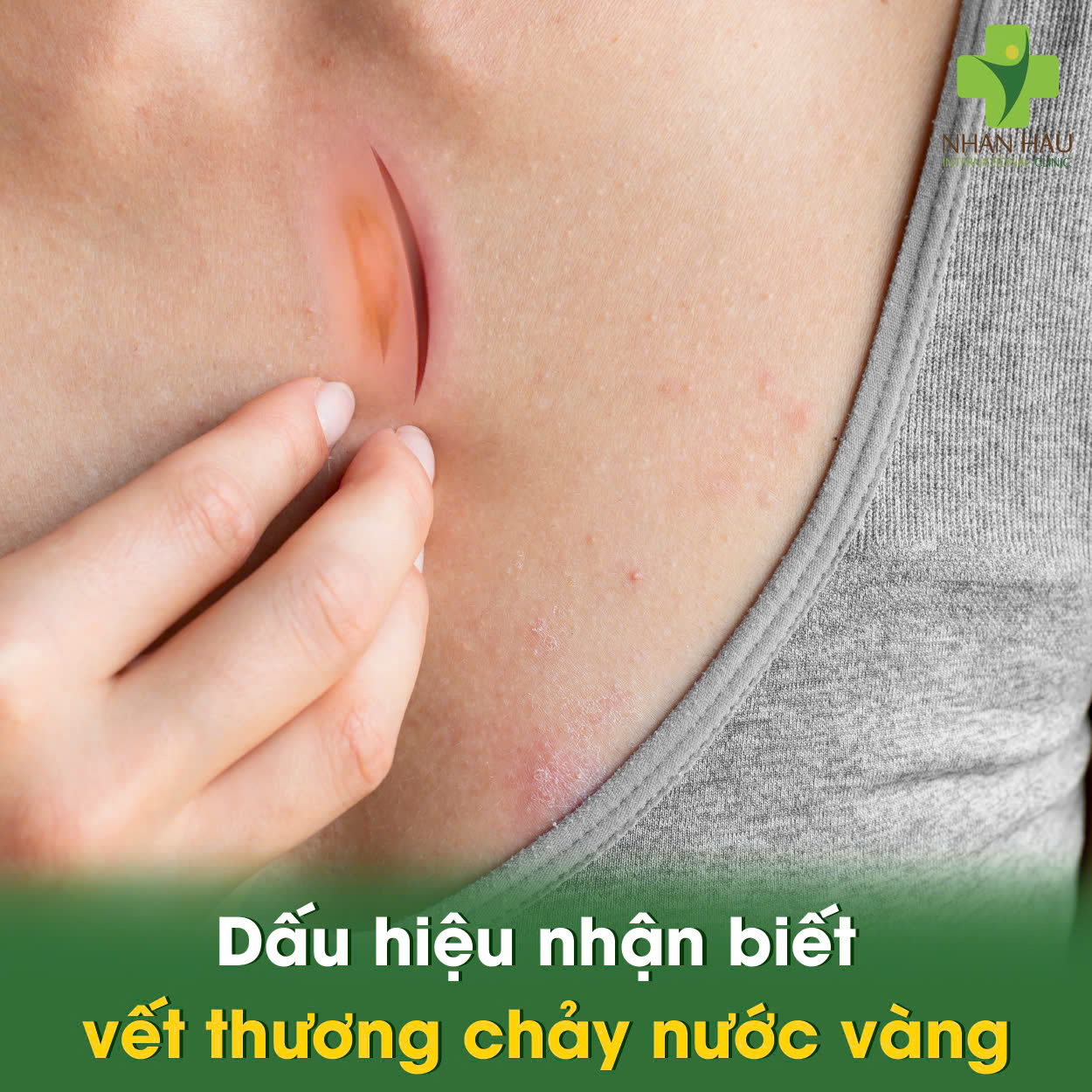 Vết Thương Chảy Nước Vàng: Nguyên Nhân, Dấu Hiệu và Cách Xử Lý 3 Dấu hiệu nhận biết vết thương chảy nước vàng