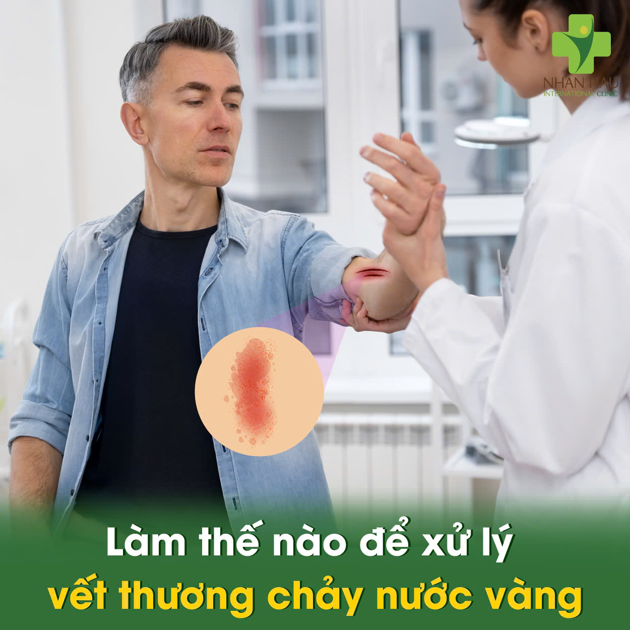 Vết Thương Chảy Nước Vàng: Nguyên Nhân, Dấu Hiệu và Cách Xử Lý 5 Làm thế nào để xử lý vết thương chảy nước vàng