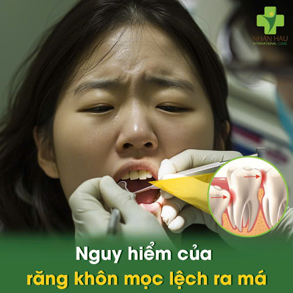 Răng Khôn Mọc Lệch Ra Má, Cắn Má - Đừng Chờ Đợi! Tìm Hiểu Nguy Hiểm Và Cách Xử Trí 4 Nguy hiểm của răng khôn mọc lệch ra má