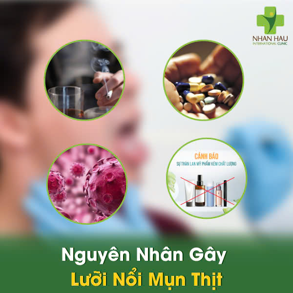 Lưỡi Nổi Mụn Thịt: Phân Biệt Loại Mụn, Nguyên Nhân và Cách Điều Trị Hiệu Quả 2 Nguyên Nhân Gây Lưỡi Nổi Mụn Thịt