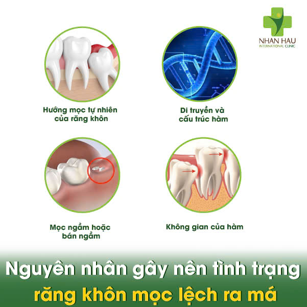 Răng Khôn Mọc Lệch Ra Má, Cắn Má - Đừng Chờ Đợi! Tìm Hiểu Nguy Hiểm Và Cách Xử Trí 2 Nguyên nhân gây nên tình trạng răng khôn mọc lệch ra má