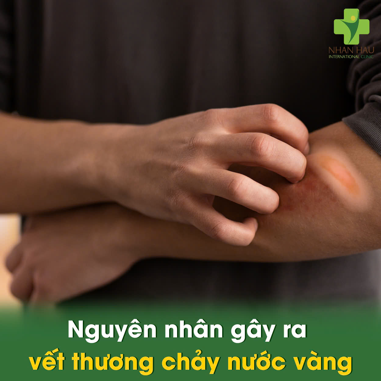 Vết Thương Chảy Nước Vàng: Nguyên Nhân, Dấu Hiệu và Cách Xử Lý 2 Nguyên nhân gây ra vết thương chảy nước vàng