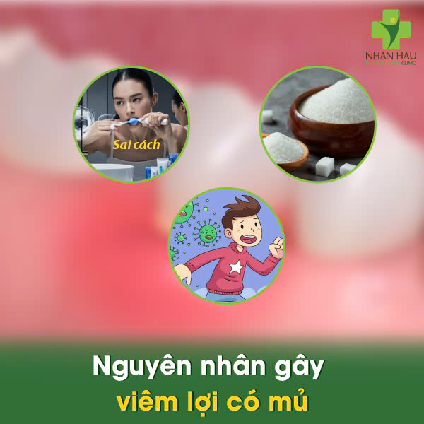 Viêm Lợi Có Mủ: Nguyên Nhân và Cách Điều Trị An Toàn 2 Nguyên nhân gây viêm lợi có mủ