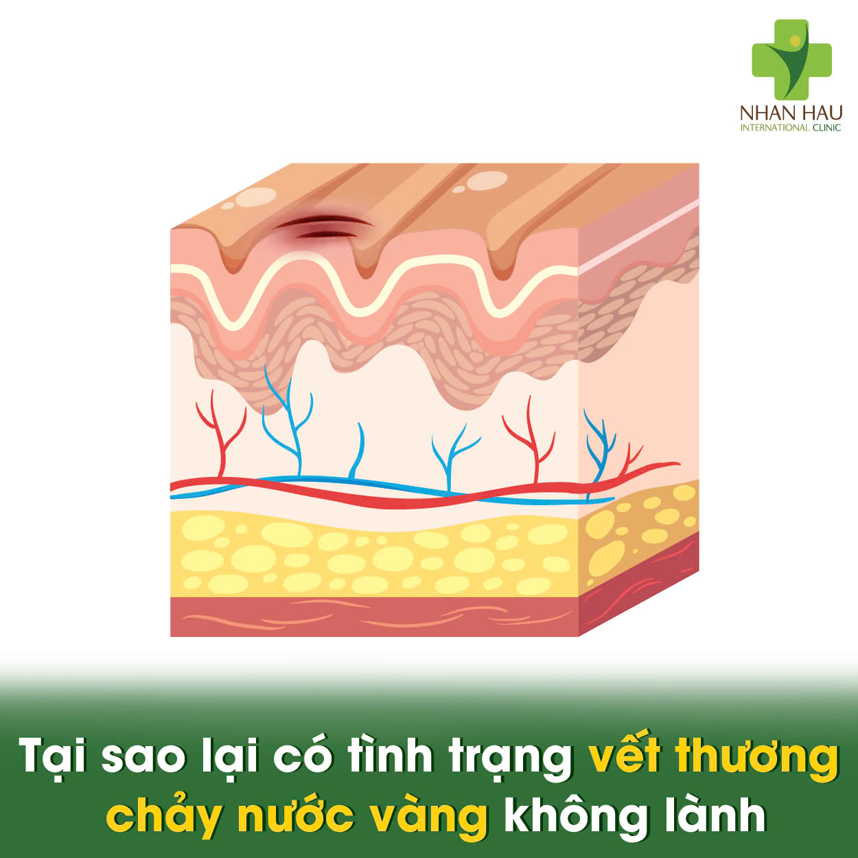 Vết Thương Chảy Nước Vàng: Nguyên Nhân, Dấu Hiệu và Cách Xử Lý 6 Tại sao vết thương bị chảy nước vàng?
