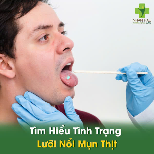 Lưỡi Nổi Mụn Thịt: Phân Biệt Loại Mụn, Nguyên Nhân và Cách Điều Trị Hiệu Quả 1 Tìm Hiểu Tình Trạng Lưỡi Nổi Mụn Thịt