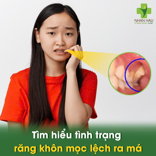 Răng Khôn Mọc Lệch Ra Má, Cắn Má - Đừng Chờ Đợi! Tìm Hiểu Nguy Hiểm Và Cách Xử Trí 1 Tìm hiểu tình trạng răng khôn mọc lệch ra má