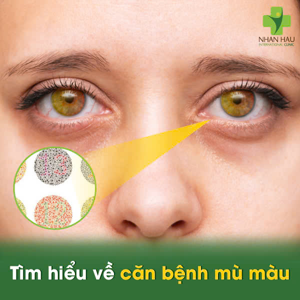 Kiểm Tra Nhanh với Bảng Kiểm Tra Mù Màu: Bạn Có Bị Rối Loạn Sắc Giác (Mù Màu) Không? 1 Tìm hiểu về căn bệnh mù màu