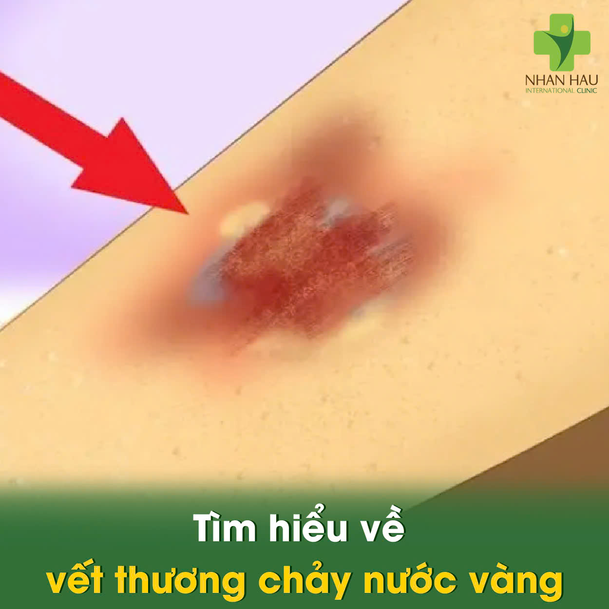 Vết Thương Chảy Nước Vàng: Nguyên Nhân, Dấu Hiệu và Cách Xử Lý 1 Tìm hiểu về vết thương chảy nước vàng