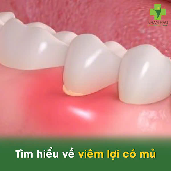 Viêm Lợi Có Mủ: Nguyên Nhân và Cách Điều Trị An Toàn 1 Tìm hiểu về viêm lợi có mủ