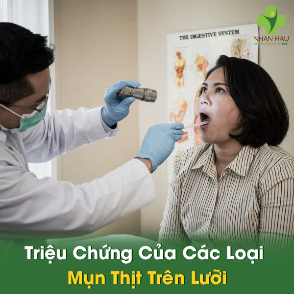 Lưỡi Nổi Mụn Thịt: Phân Biệt Loại Mụn, Nguyên Nhân và Cách Điều Trị Hiệu Quả 4 Triệu Chứng Của Các Loại Mụn Thịt Trên Lưỡi