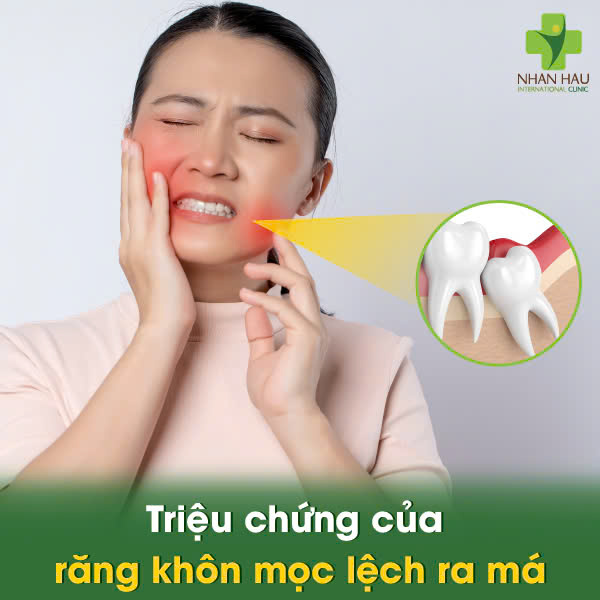 Răng Khôn Mọc Lệch Ra Má, Cắn Má - Đừng Chờ Đợi! Tìm Hiểu Nguy Hiểm Và Cách Xử Trí 3 Triệu chứng của răng khôn mọc lệch ra má