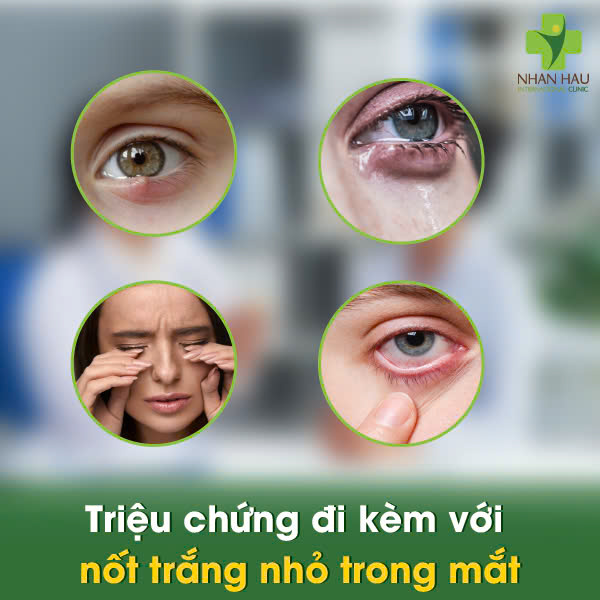 Phát Hiện Nốt Trắng Nhỏ Trong Mắt? Giữ Bình Tĩnh và Tìm Hiểu Nguyên Nhân! 3 Triệu chứng đi kèm với nốt trắng nhỏ trong mắt