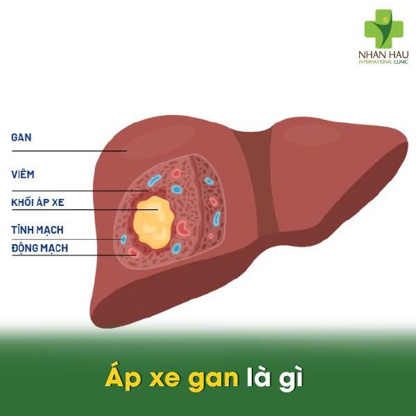 Áp xe gan: Nguyên Nhân, Triệu Chứng và Những biến chứng nguy hiểm 1 Áp xe gan là gì