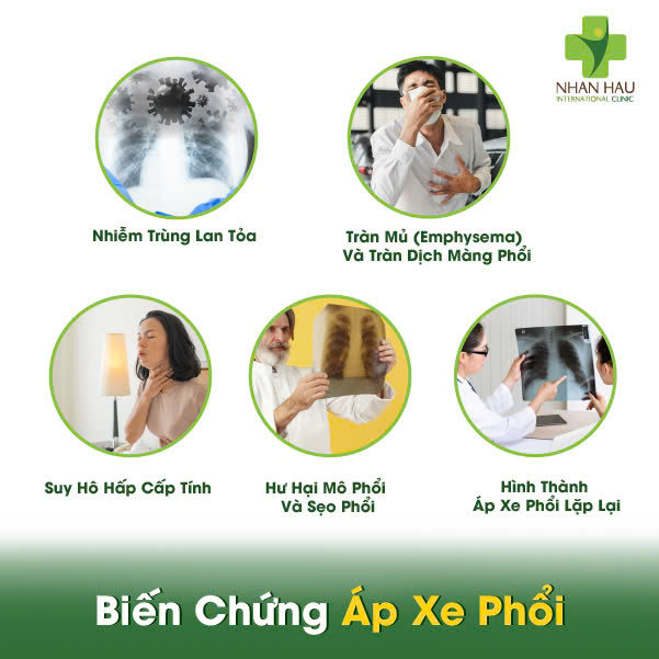 Áp Xe Phổi: Triệu Chứng, Nguyên Nhân và Điều Trị 4 Biến Chứng Áp Xe Phổi