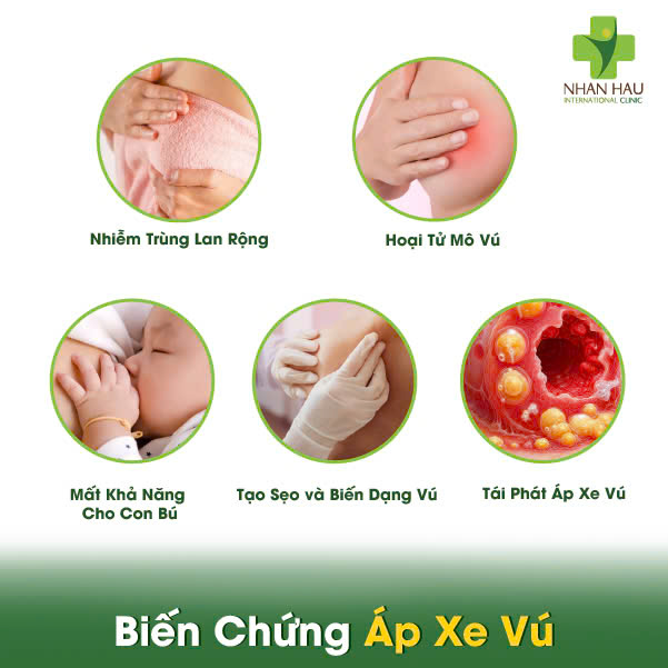 Áp Xe Vú: Triệu Chứng, Nguyên Nhân và Điều Trị 4 Biến Chứng Áp Xe Vú