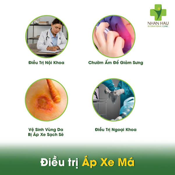 Áp Xe Má: Nhận Biết, Điều Trị, Phòng Ngừa 5 Điều trị Áp Xe Má