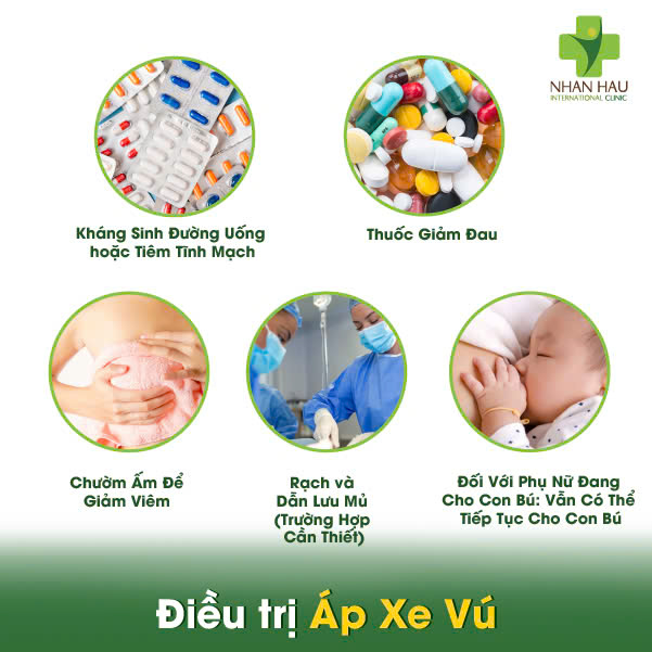 Áp Xe Vú: Triệu Chứng, Nguyên Nhân và Điều Trị 5 Điều trị Áp Xe Vú