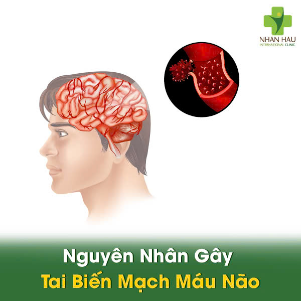 Tai biến mạch máu não: Nguyên nhân, triệu chứng và cách phòng ngừa hiệu quả 2 Nguyên Nhân Gây Tai Biến Mạch Máu Não