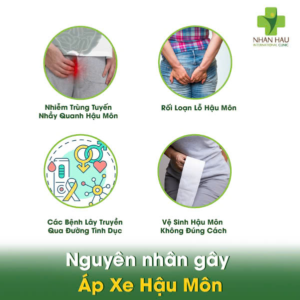 Áp Xe Hậu Môn: Triệu Chứng, Nguyên Nhân và Điều Trị 3 Nguyên nhân gây Áp Xe Hậu Môn