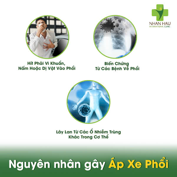 Áp Xe Phổi: Triệu Chứng, Nguyên Nhân và Điều Trị 3 Nguyên nhân gây Áp Xe Phổi