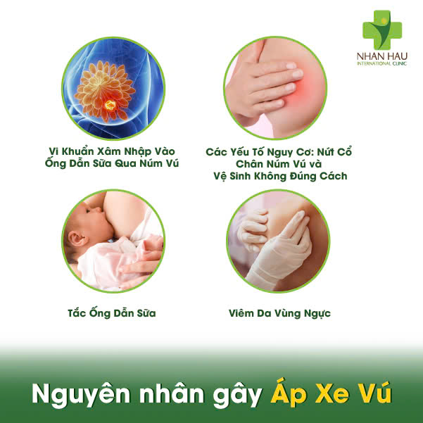 Áp Xe Vú: Triệu Chứng, Nguyên Nhân và Điều Trị 3 Nguyên nhân gây Áp Xe Vú