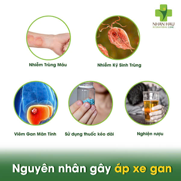 Áp xe gan: Nguyên Nhân, Triệu Chứng và Những biến chứng nguy hiểm 2 Nguyên nhân gây áp xe gan