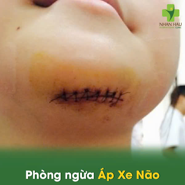 Áp Xe Não: Tình Trạng Nguy Hiểm - Cần Được Cấp Cứu Y Tế Ngay Lập tức 7 Phòng Ngừa Áp Xe Não