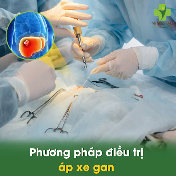 Áp xe gan: Nguyên Nhân, Triệu Chứng và Những biến chứng nguy hiểm 5 Phương pháp điều trị áp xe gan