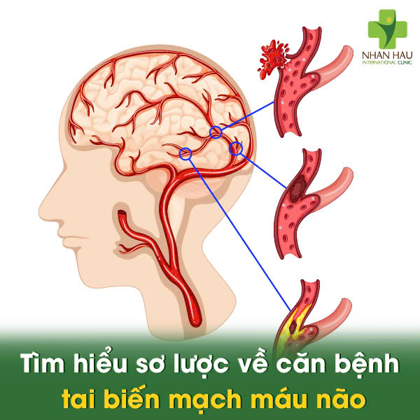 Giờ Vàng Trong Tai Biến Mạch Máu Não: Cấp Cứu Ngay Để Cứu Sống 1 Tìm hiểu sơ lược về căn bệnh tai biến mạch máu não