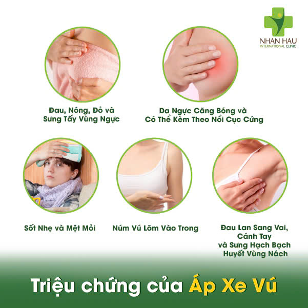 Áp Xe Vú: Triệu Chứng, Nguyên Nhân và Điều Trị 2 Triệu chứng của Áp Xe Vú