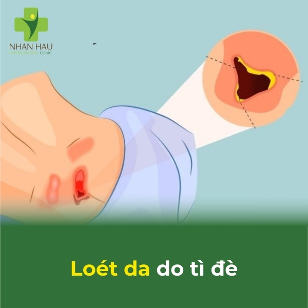 Chi tiết kế hoạch chăm sóc người bệnh tai biến mạch máu não 4 biến chứng loét da do tì đè lâu
