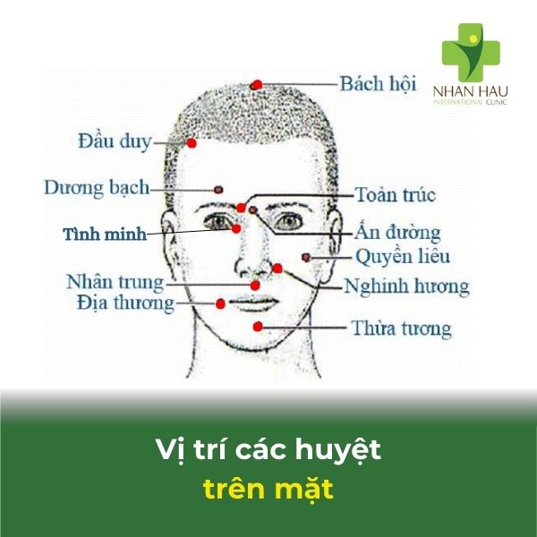Cách bấm huyệt cho người bị tai biến mạch máu não 9 vị trí các huyệt trên mặt