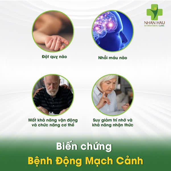 Bệnh Động Mạch Cảnh: Nguyên Nhân, Triệu Chứng và Phòng Ngừa 4 Biến chứng Bệnh Động Mạch Cảnh