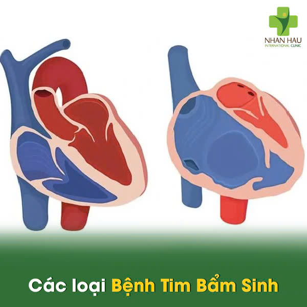 Bệnh Tim Bẩm Sinh: Nguyên nhân, triệu chứng và cách phát hiện 3 Các loại Bệnh Tim Bẩm Sinh