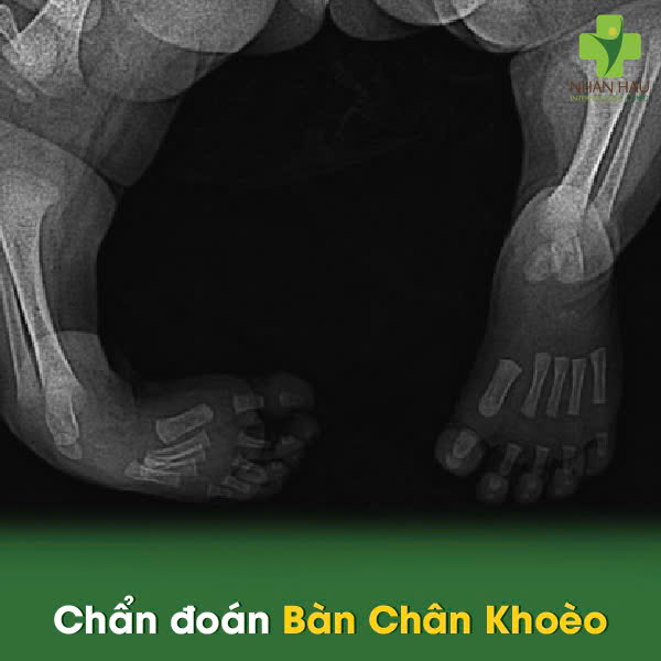 Bàn Chân Khoèo: Nguyên Nhân, Dấu Hiệu và Điều Trị Hiệu Quả 4 Chẩn đoán Bàn Chân Khoèo