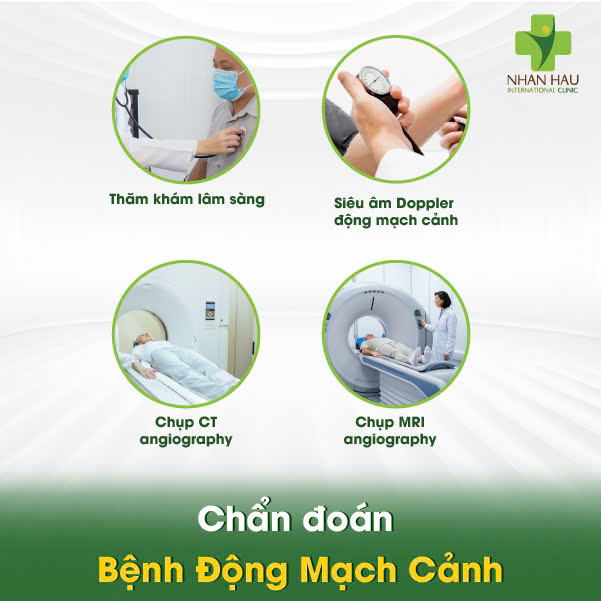 Bệnh Động Mạch Cảnh: Nguyên Nhân, Triệu Chứng và Phòng Ngừa 5 Chẩn đoán Bệnh Động Mạch Cảnh